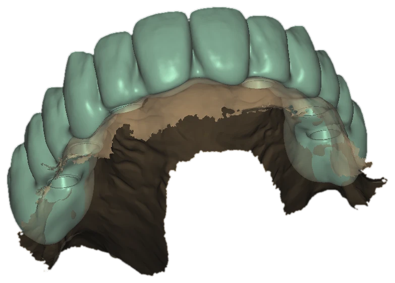 Upper full-arch design over a palate scan, front view