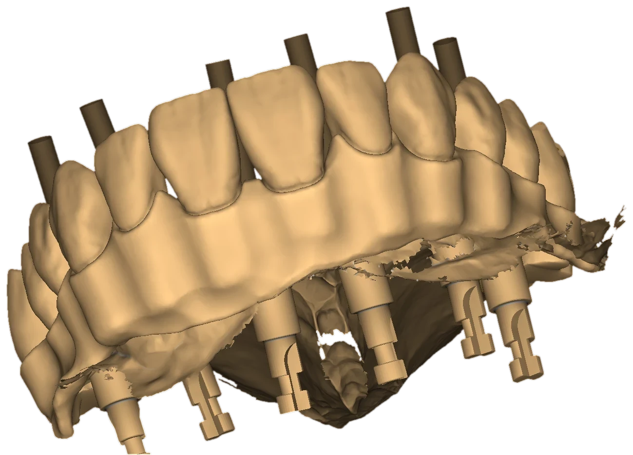 Working CAD view: monolithic full-arch design on implant analog pins, three-quarter view