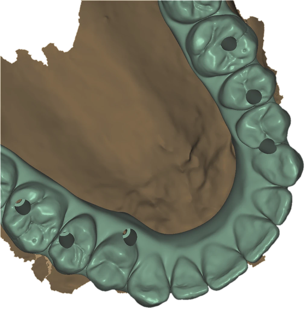 Occlusal view of a lower full-arch hybrid design with screw access channels, over a soft-tissue scan
